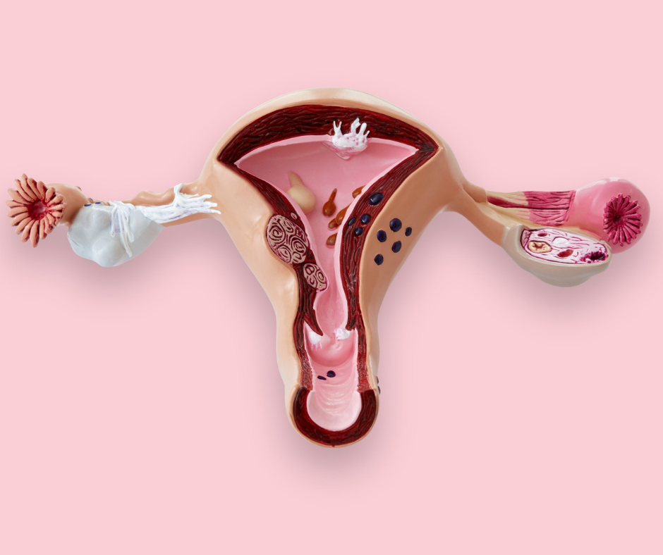 Syndrome des ovaires polykystiques (SOPK) : causes, traitements de ce  trouble hormonal