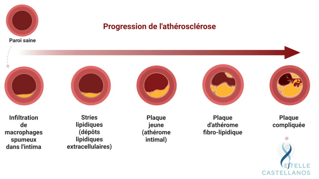 Schéma de la progression de l'athérosclérose, de la paroi saine à la plaque compliquée, en cinq étapes.